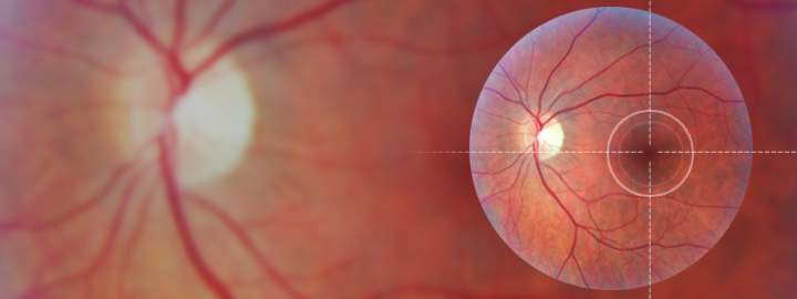 Macular Degeneration
